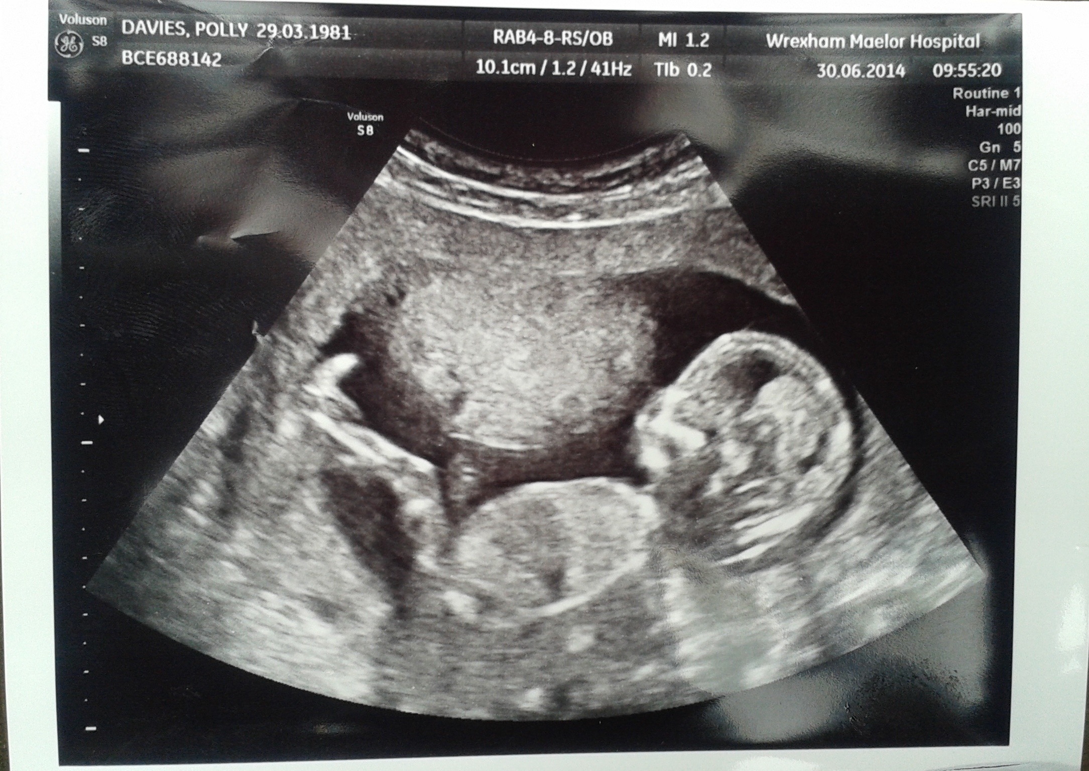 15 week ultrasound picture